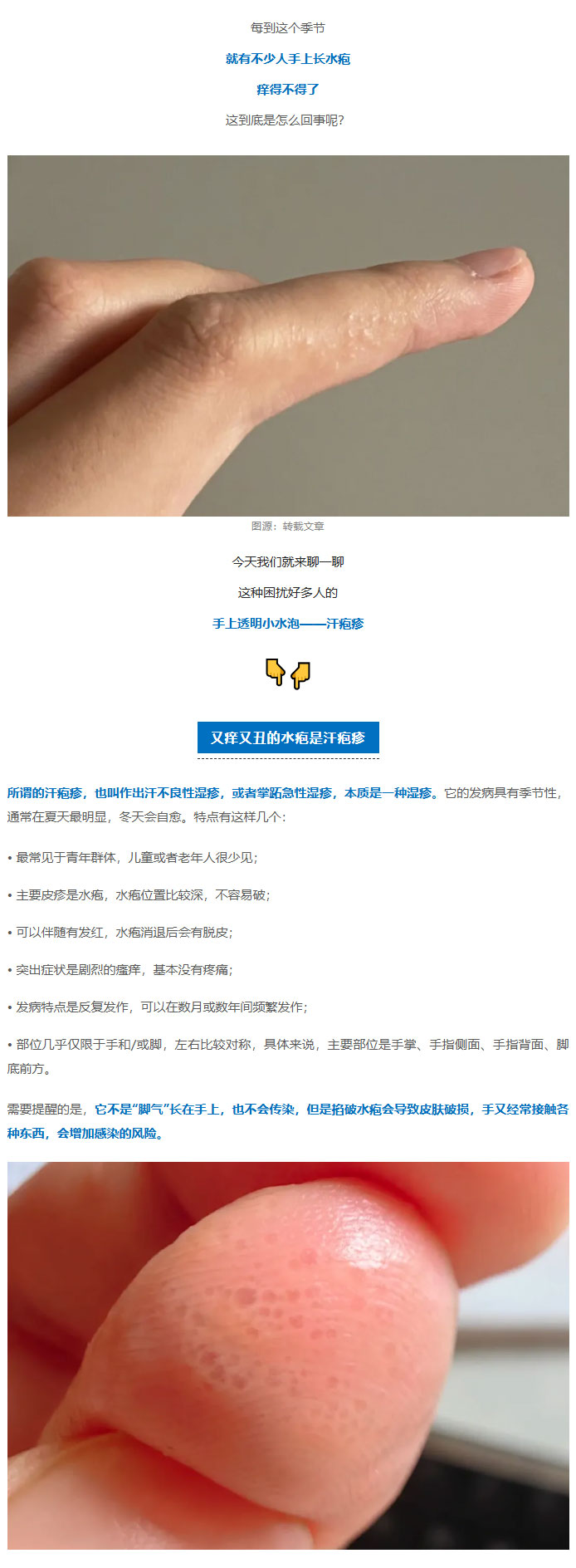 为什么一到夏天，手上就长透明小水泡？01.jpg